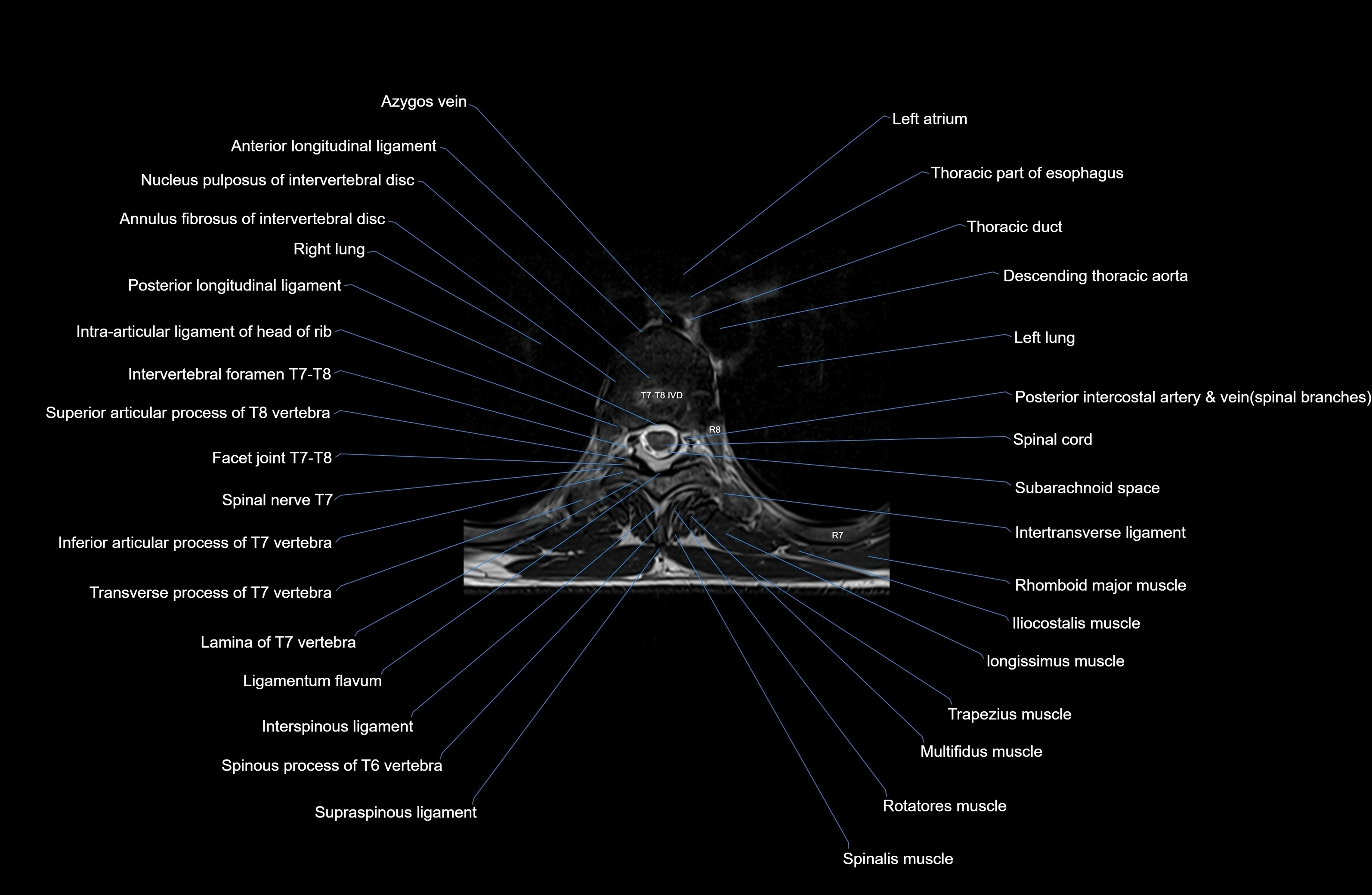 MRI thoracic spine axial  cross sectional anatomy 3T radiology  image-img-00001-00048.webp
